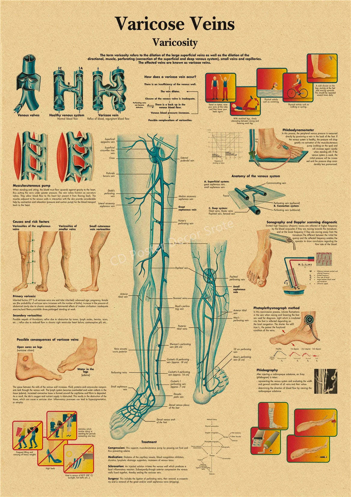 Vintage anatomy and physiology poster illustrating varicose veins, venous valves, and the anatomy of the venous system.