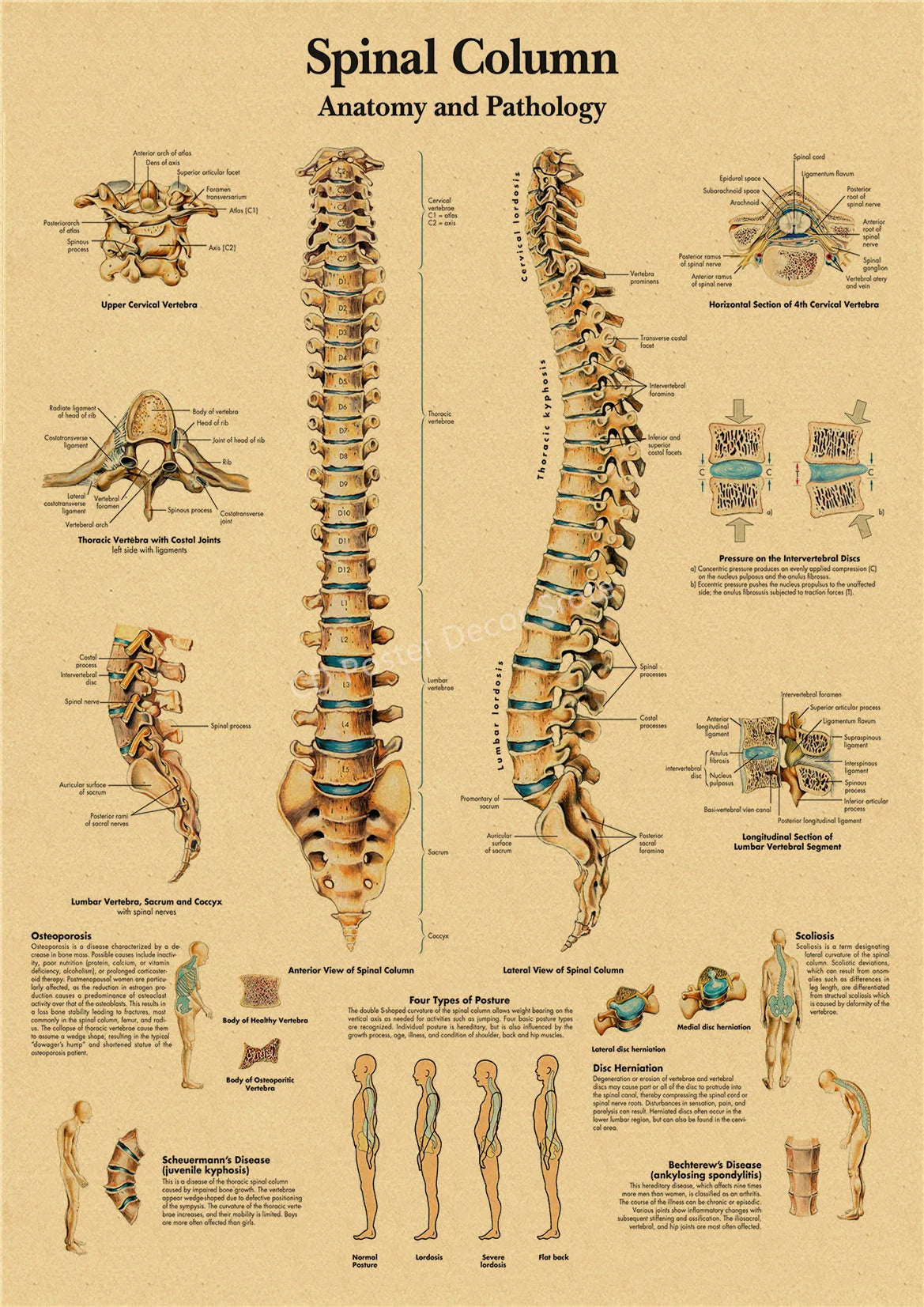 Vintage anatomy and pathology poster showing the spinal column anatomy and pathology.