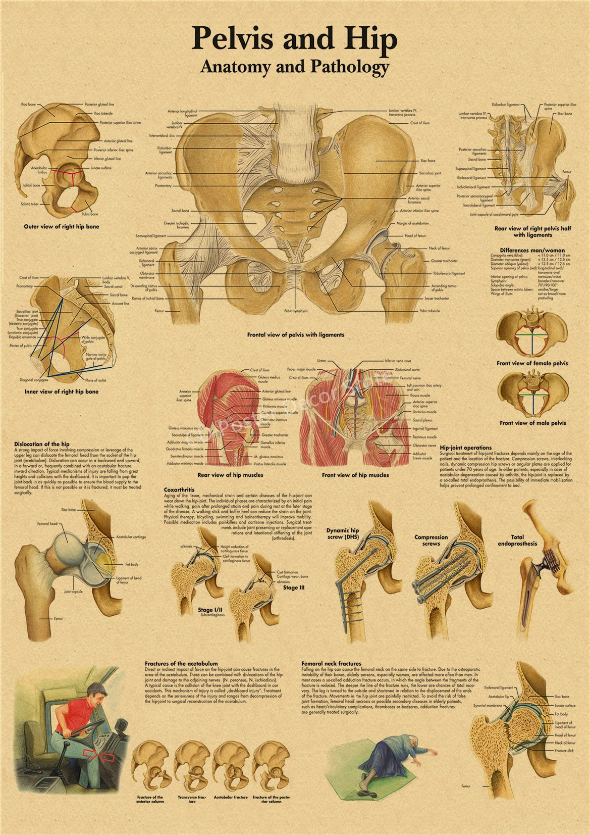 Vintage anatomy and pathology poster showing detailed diagrams of the pelvis and hip anatomy and pathology.